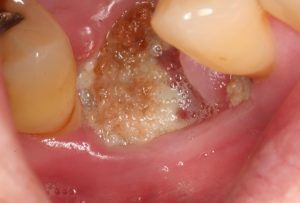عفونت بعد از کشیدن دندان