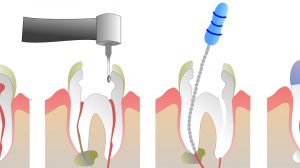مدت عصب کشی دندان