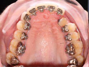 ارتودنسی لینگوال فک بالا