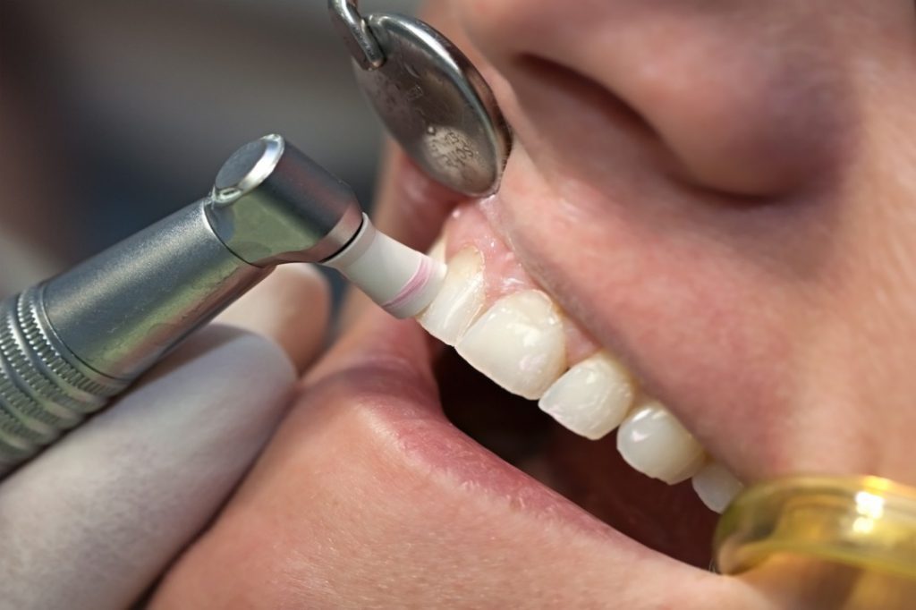 بروساژ یا پولیش دندان و کاربردهای آن
