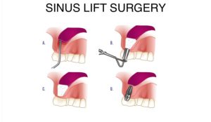 بعد از لیفت سینوس چه اتفاقی می افتد