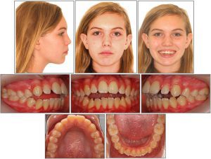 تشخیص اپن بایت