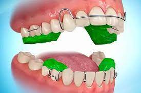 درمان آندربایت