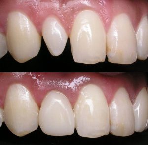 روشهای زیبایی لبخند