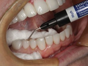 روش استفاده کامپوزیت فلو