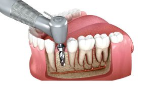 روش ایمپلنت اندوستیال
