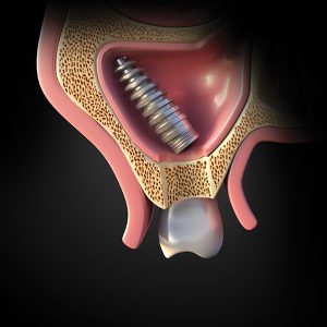عوارض سینوس لیفت