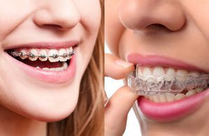 مقایسه بریس های دیمون با اینویزیلاین