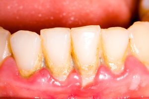 پریودنتیت چگونه شکل می گیرد؟