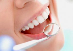 مراحل لمینت دندان