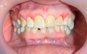 میزان تراش مینای دندان