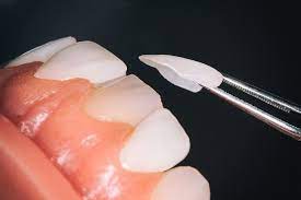 ارزیابی لمینت دندان