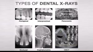 انواع عکس رادیولوژی دندان