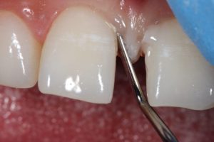 درمان شکاف دندان