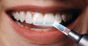 عوامل موثر بر طول عمر مینای دندان