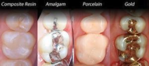 مزایای مواد ترمیم دندان