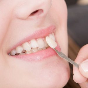 کامپوزیت دندان ماندگارتر است یا لمینت دندان