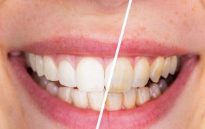 تاثیر جرم گیری عمیق