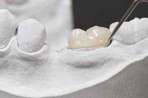 روش های ترمیم تاج دندان