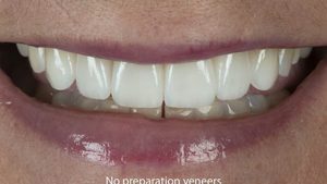 طراحی دیجیتال لنز دندانی
