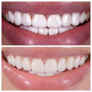 قبل و بعد درمان لنز دندانی