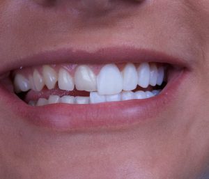 نحوه جلوگیری از ایجاد دندان های حساس بعد از روکش