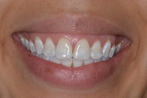 درمان لکه سفید دندان