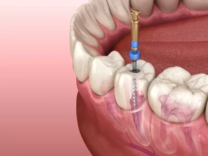 آیا بعد از عصب کشی دندان مشکلات احتمالی وجود دارد؟