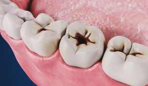 ایجاد پوسیدگی دندان