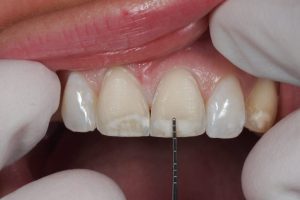 حساسیت بعد از روکش دندان