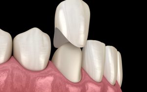 شایع ترین عوارض جانبی روکش دندان چیست؟
