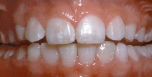 علت لکه سفید دندان