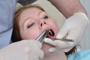 مراقبت بعد از کشیدن دندان