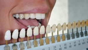 موارد موثر در استحکام کامپوزیت دندان چیست؟