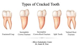 انواع ترک خوردگی دندان