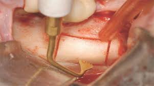 جراحی فک با piezosurgery