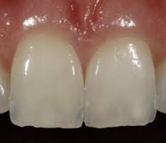 درمان ترک مویی