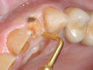 کشیدن دندان با پیزوسرجری