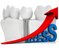 میزان موفقیت ایمپلنت دندان