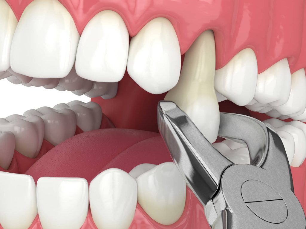کشیدن دندان و اطلاعات لازم