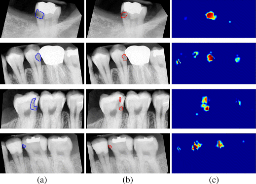 تشخیص پوسیدگی دندان با رادیوگرافی
